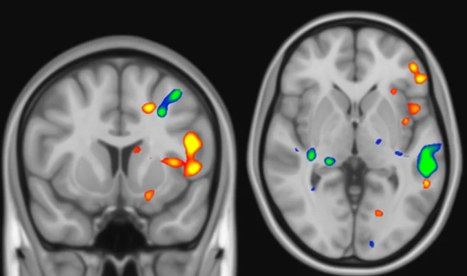 MRI Example